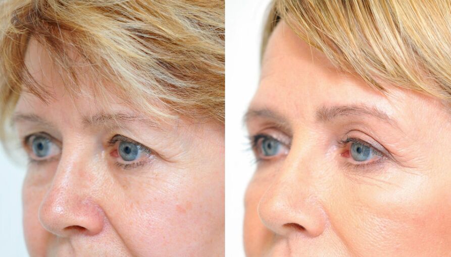 Blefaroplastia antes e despois